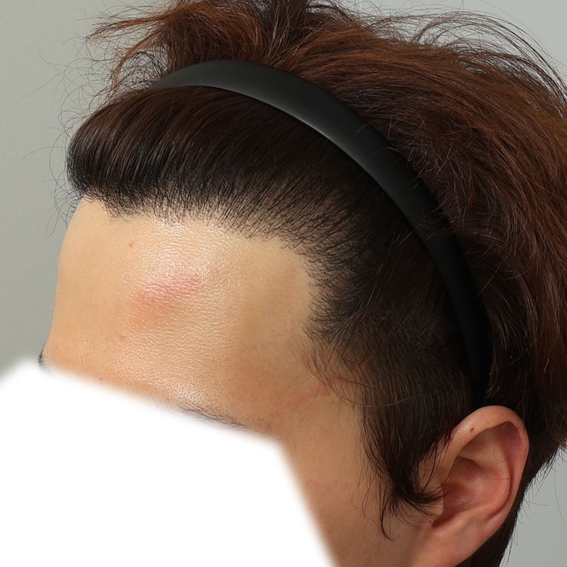 수술후#377D_3.jpg