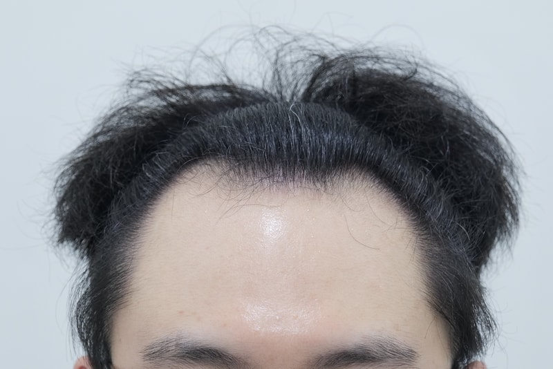 연세모에버의원 절개 3500모 벌써 2년 지났네요