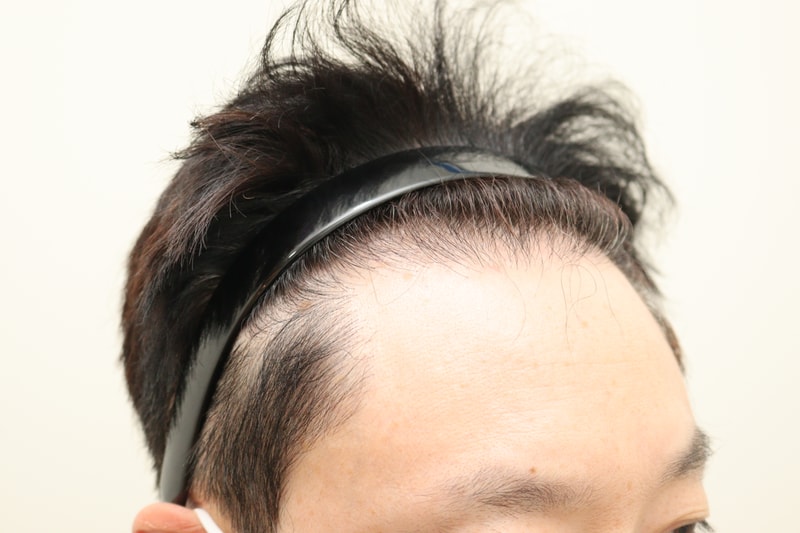 1. 수술전_3.JPG
