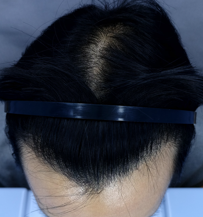 2500모 이식전 정수리.png
