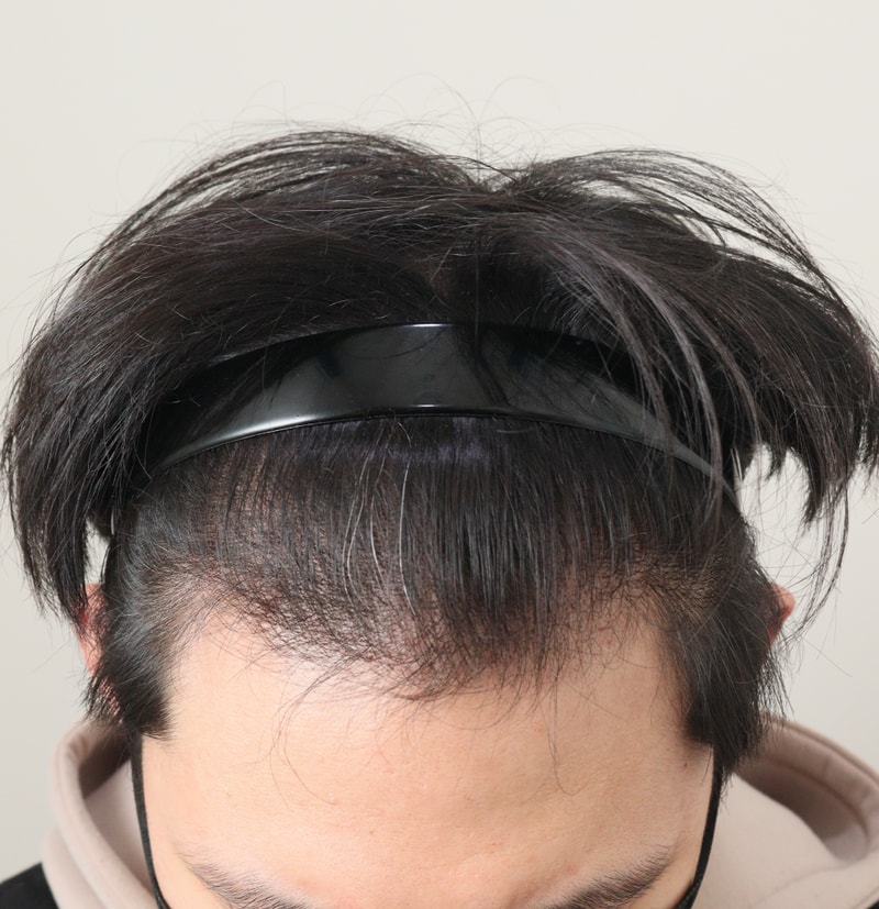 3. 수술후_7개월_2.JPG