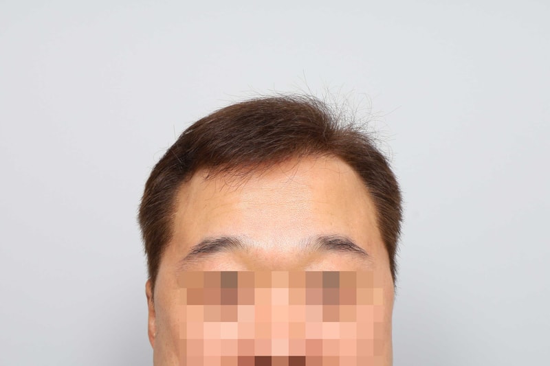모원성형외과 헤어라인, 눈썹 마이크로 모발이식 수술 2주 후기입니다
