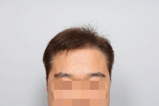 수술-후-2주1.png