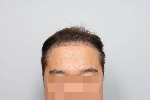 수술-후-2주2.png