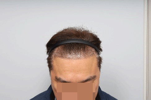 _수술-후-2주3.png