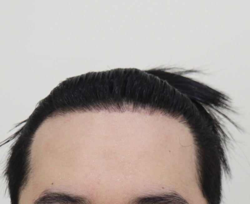 4. 수술후_1년_1.JPG