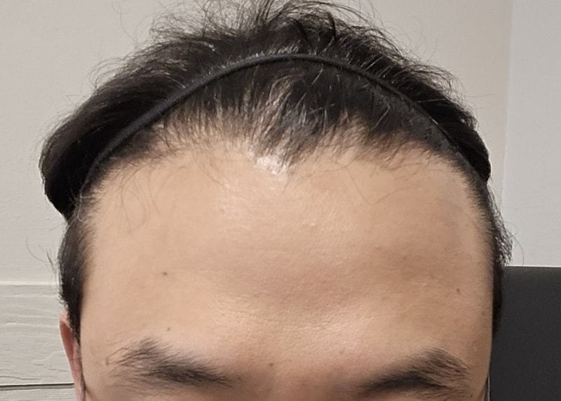 포헤어 부산점 비절개무삭발 슬릿 모발이식 M자탈모 9개월차 후기 (박상건 원장님)