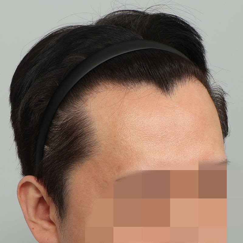 After the M-shape Hair Transplant of Seojin Plastic Surgery, it became a straight hairline from the 3-shape forehead.
