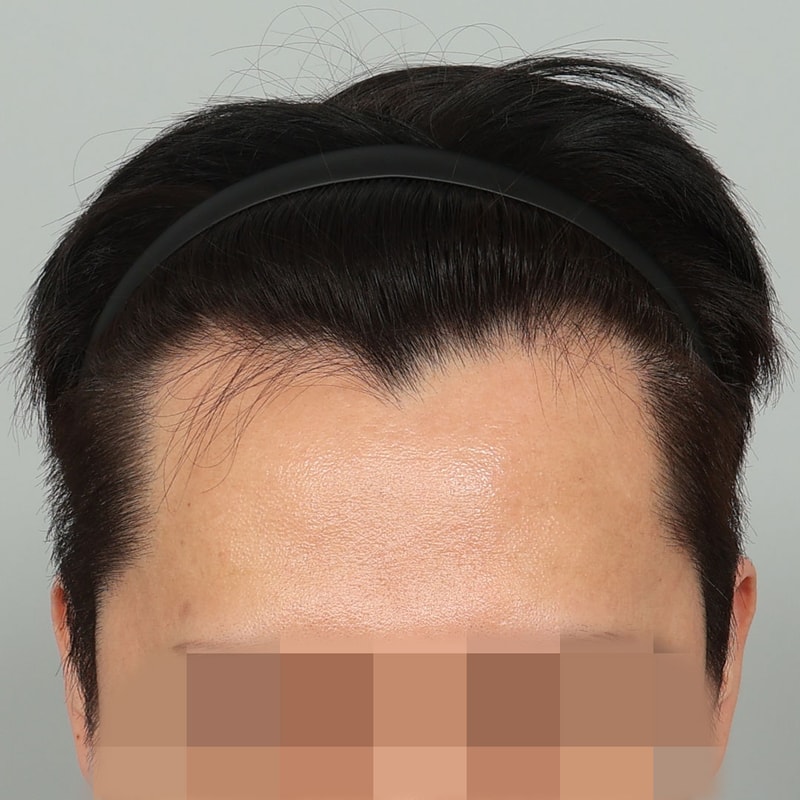 수술 전 (2).jpg