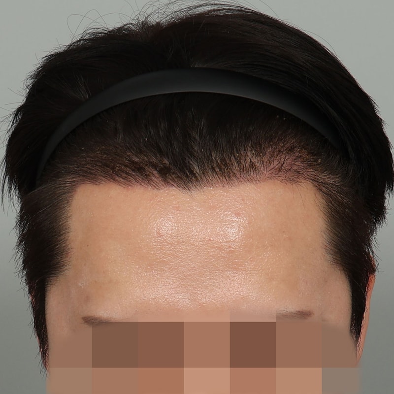 수술 후 14일차 (2).jpg
