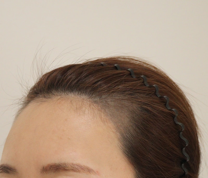 1. 수술전_3.JPG