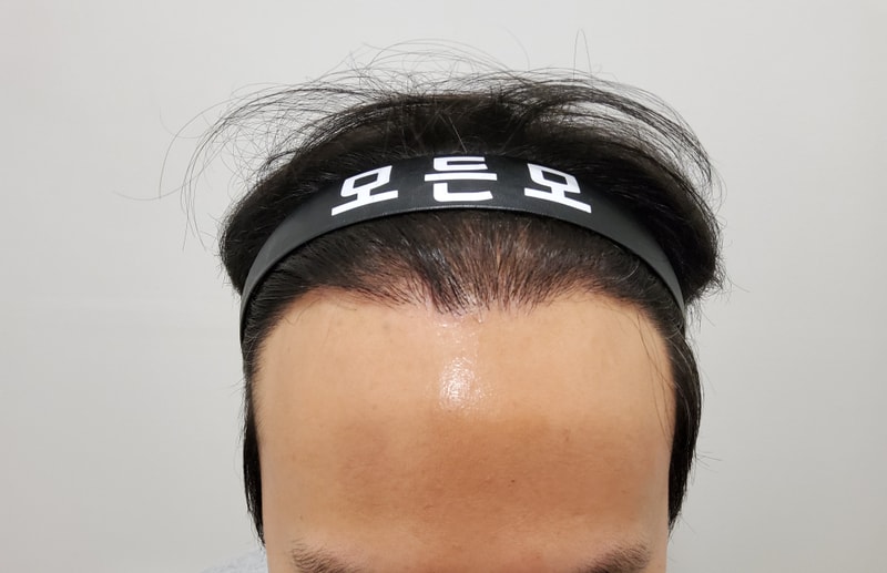 5. 수술후_1년_1.jpg