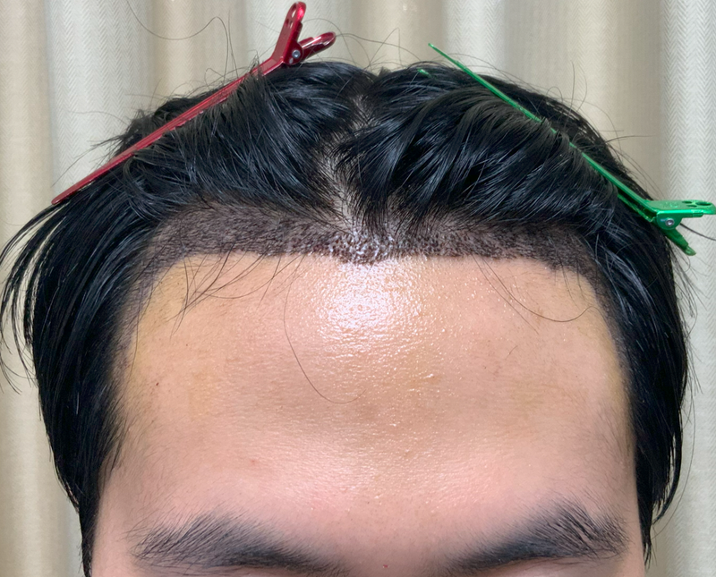 2000모 이식 7일후.png