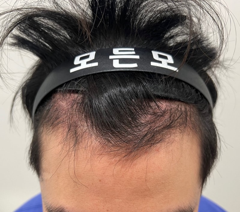 3. 수술후_3개월.jpg