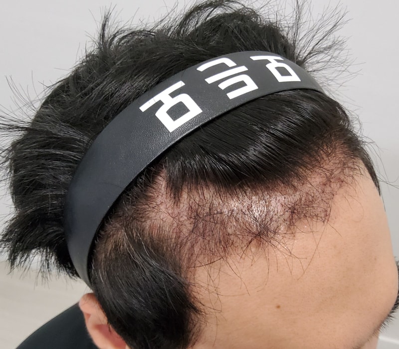 3. 수술후_3개월_2.jpg