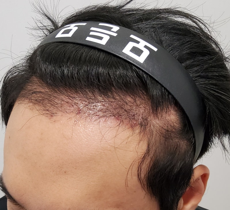 3. 수술후_3개월_3.jpg