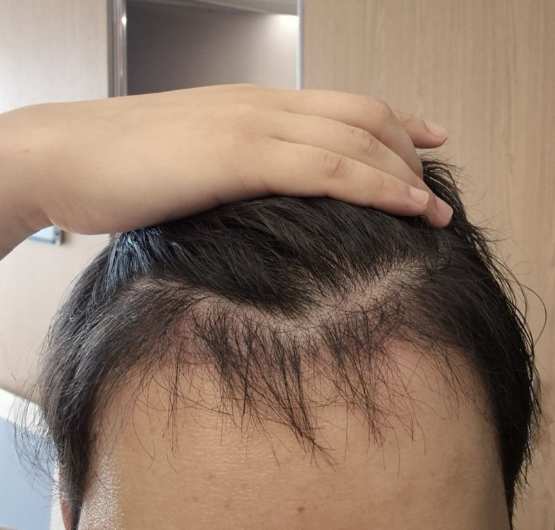 3. 수술후_3개월_셀카_1.jpg