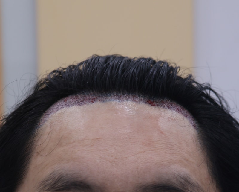 2. 수술후_당일_1.JPG
