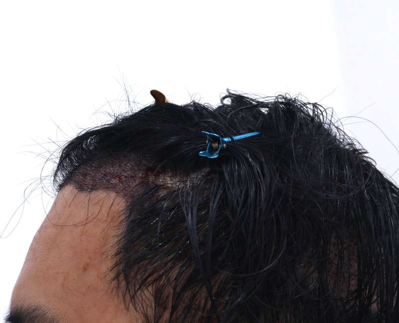 2. 수술후_1일_2.JPG