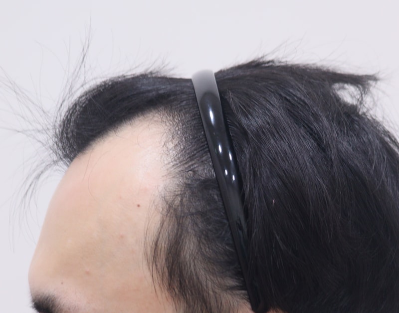 1. 수술전_2.JPG
