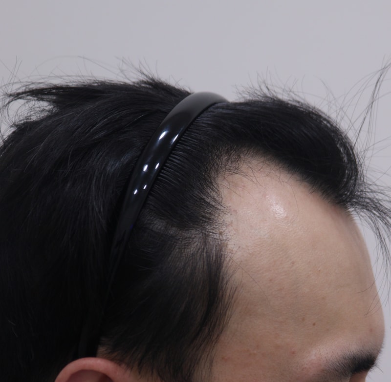 1. 수술전_3.JPG