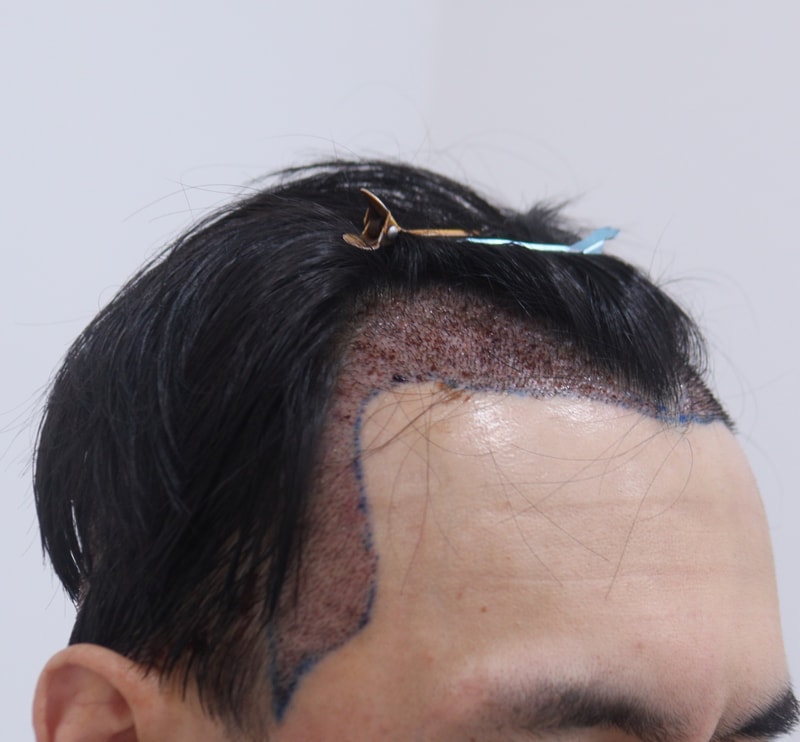 2. 수술후_1일_3.JPG