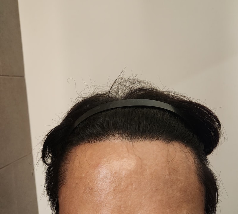 모발이식 후.jpg