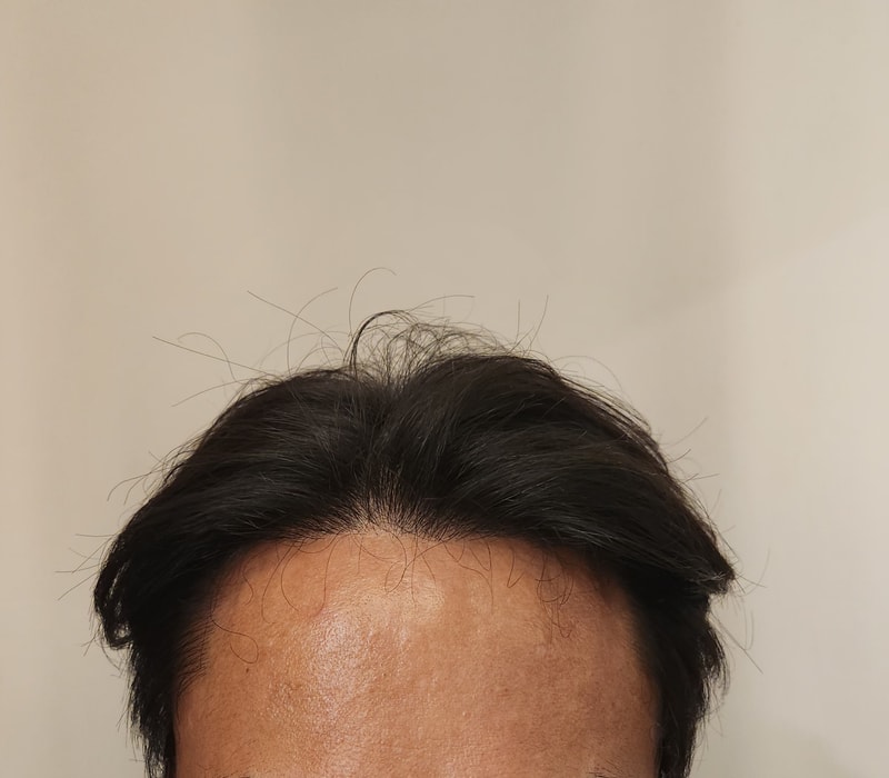 모발이식 후1.jpg