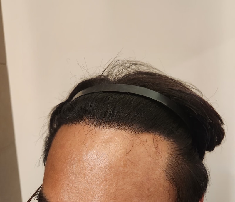 모발이식 후2.jpg