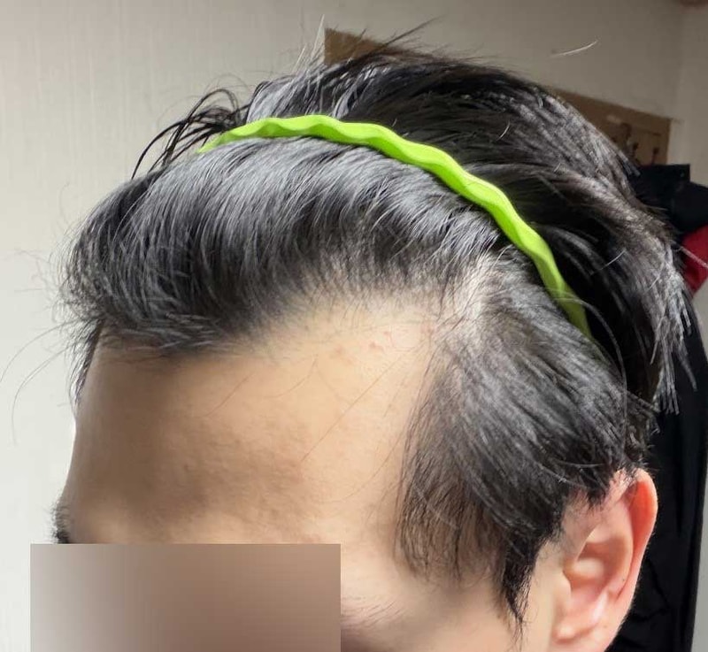 M자 이마랑 눈썹 모발이식 1750모낭 10일차 모원성형외과 정재홍원장님