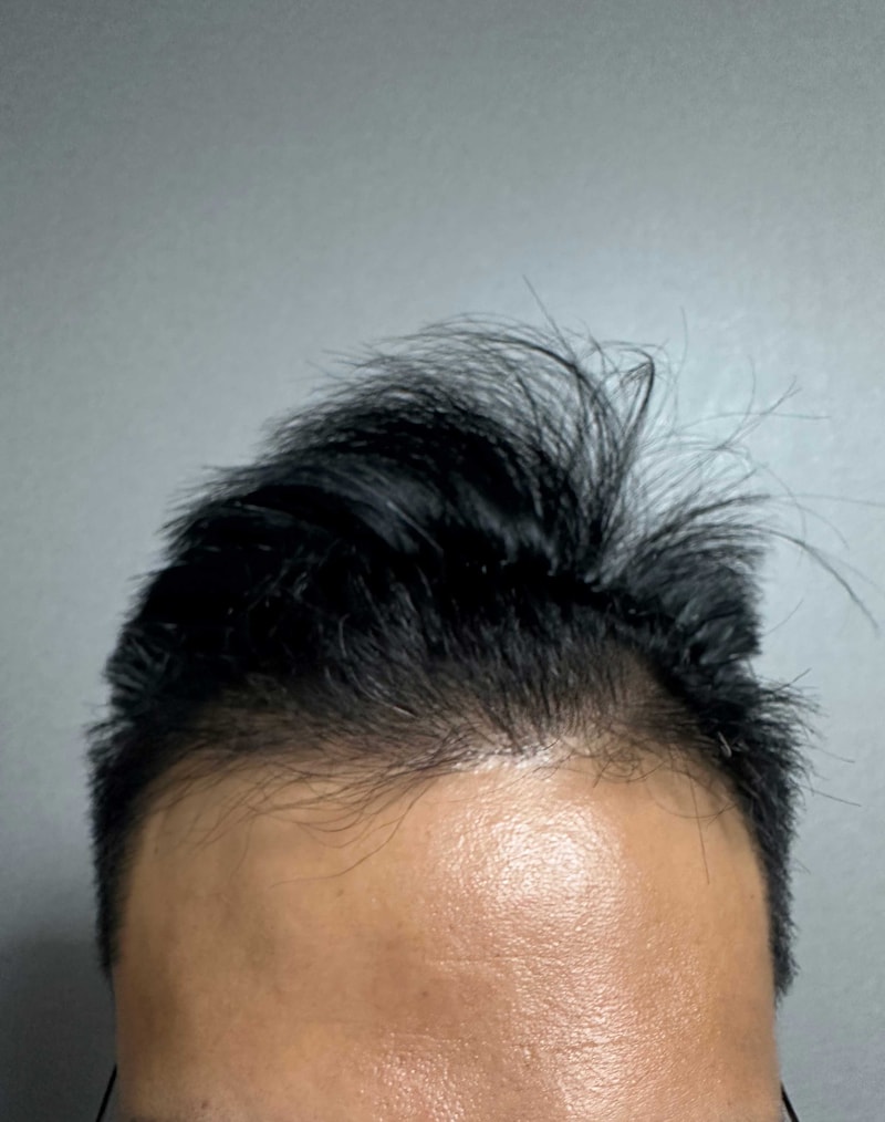 수술8개월차입니다.jpg