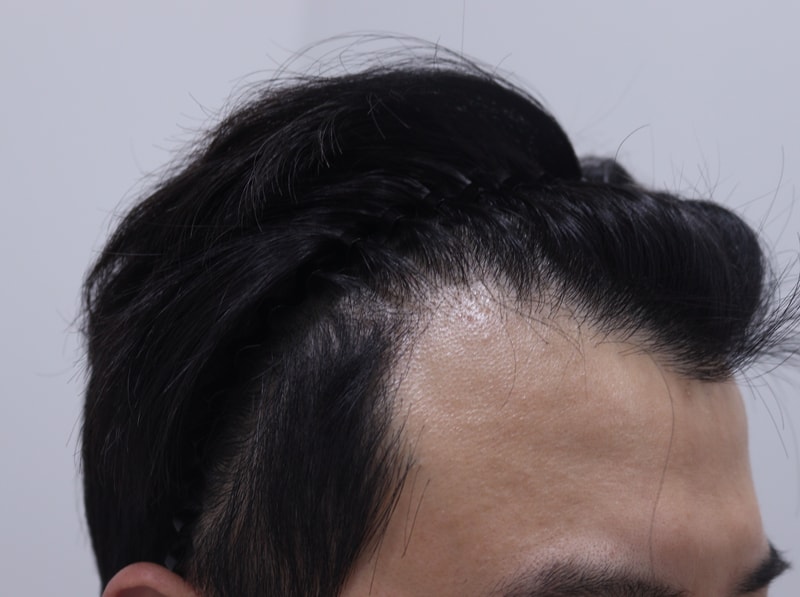 1. 수술전_3.JPG