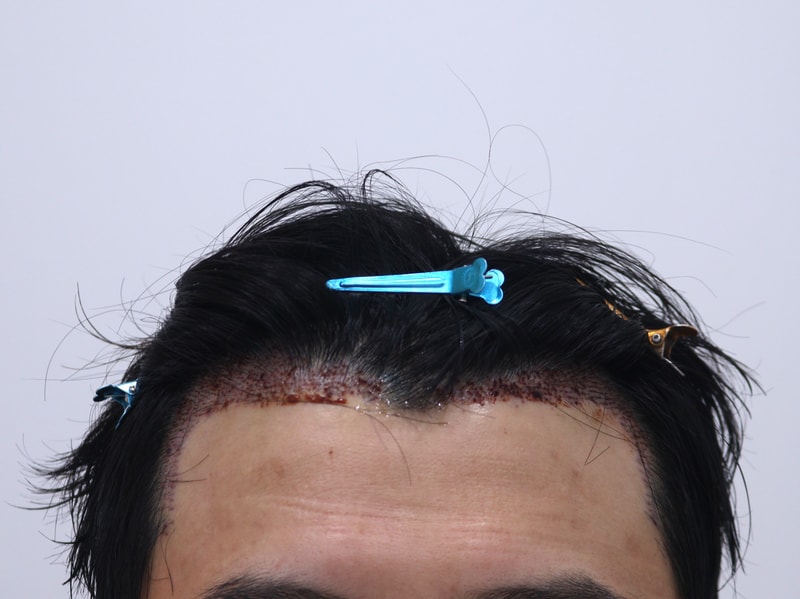 2. 수술후_1일_1.JPG