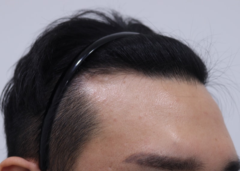 1. 수술전_3.JPG