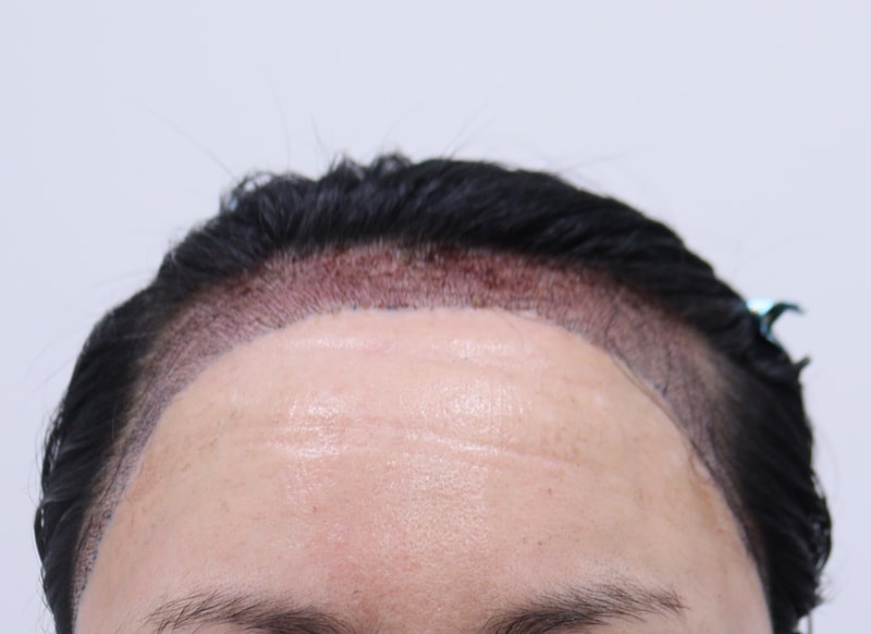 2. 수술후_1일_1.JPG