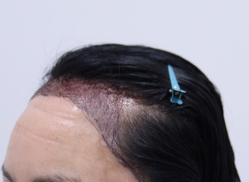 2. 수술후_1일_2.JPG