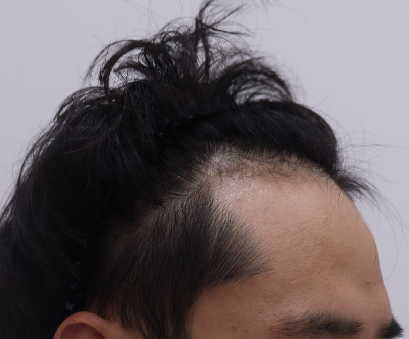 1. 수술전_3.JPG