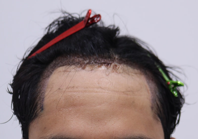 2. 수술후_1일_1.JPG