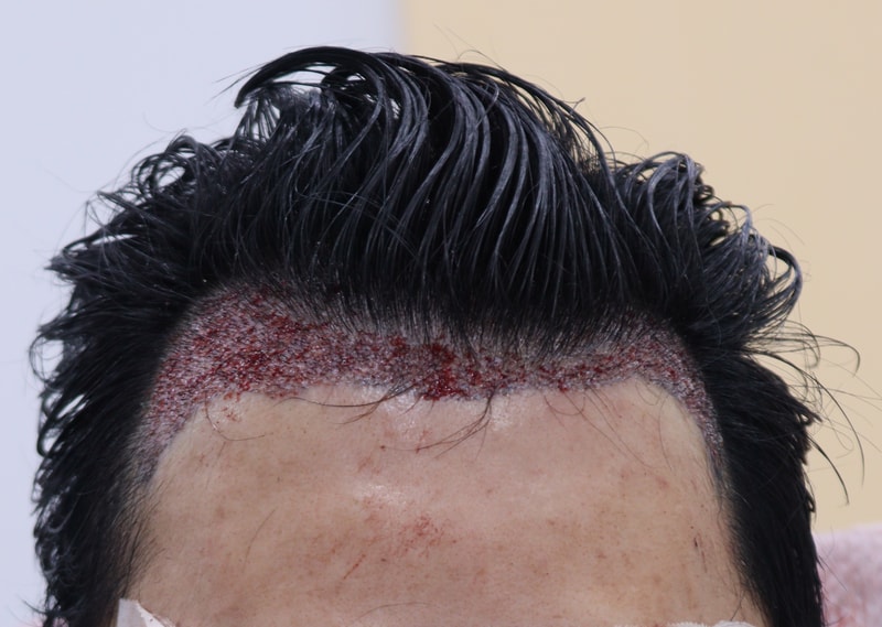 2. 수술후_1일_1.JPG