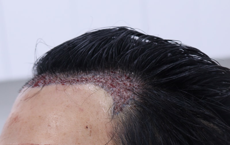 2. 수술후_1일_2.JPG