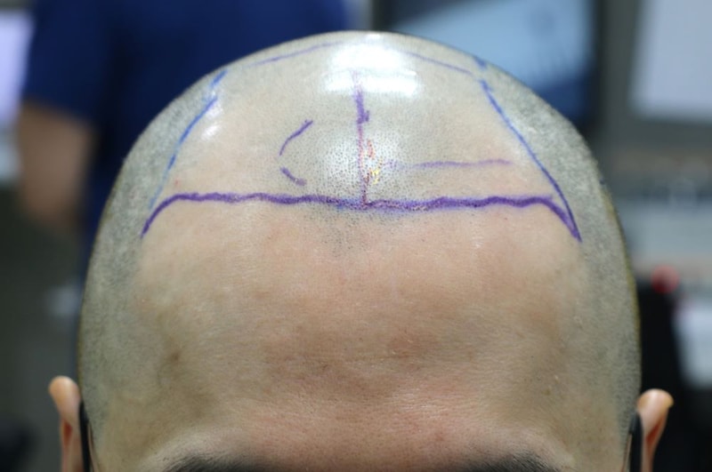 04.수술당일.JPG