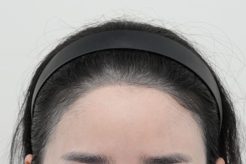 A review of the Hair Transplant of Yonsei Moever after 6 months.