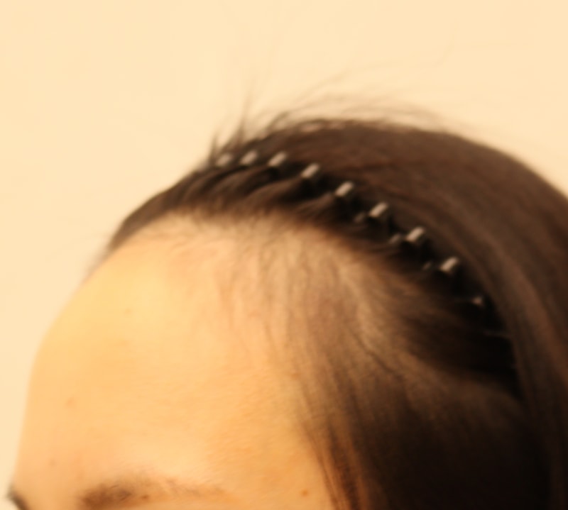 1. 수술전_2.JPG