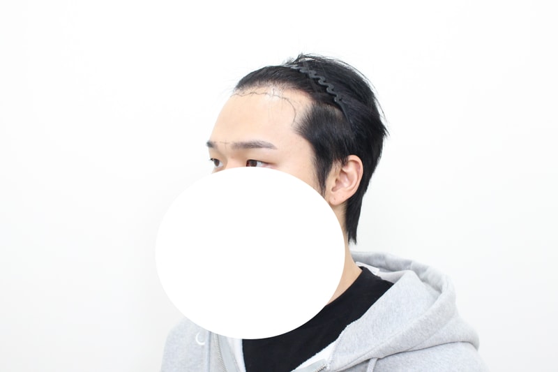 수술 상담 후 디자인 (가린사진).JPG