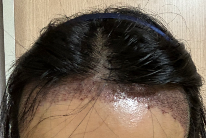 2. 수술후_1일_셀카_1.PNG