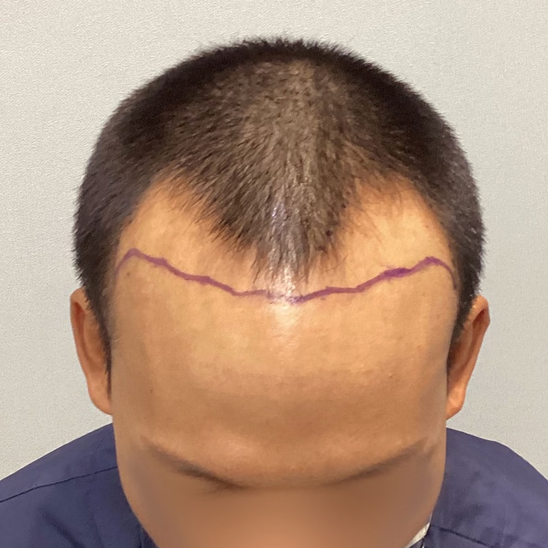 [서진성형외과] 깊은 M자로 모발이식과 PRP 주사 같이 받은 후기입니다.