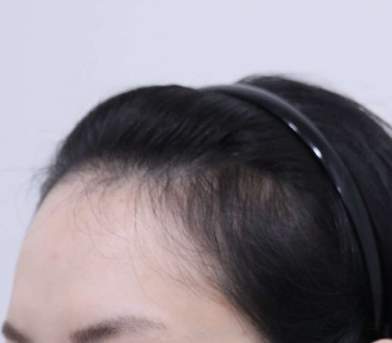 1. 수술전_2.JPG