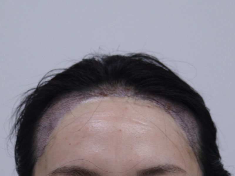 2. 수술후_1일_1.JPG
