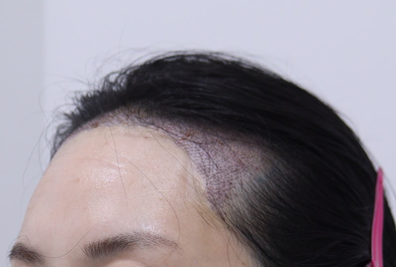 2. 수술후_1일_2.JPG