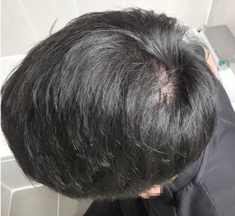 비절개 모발이식 재수술 1,800모낭 수술 2일 차 후기